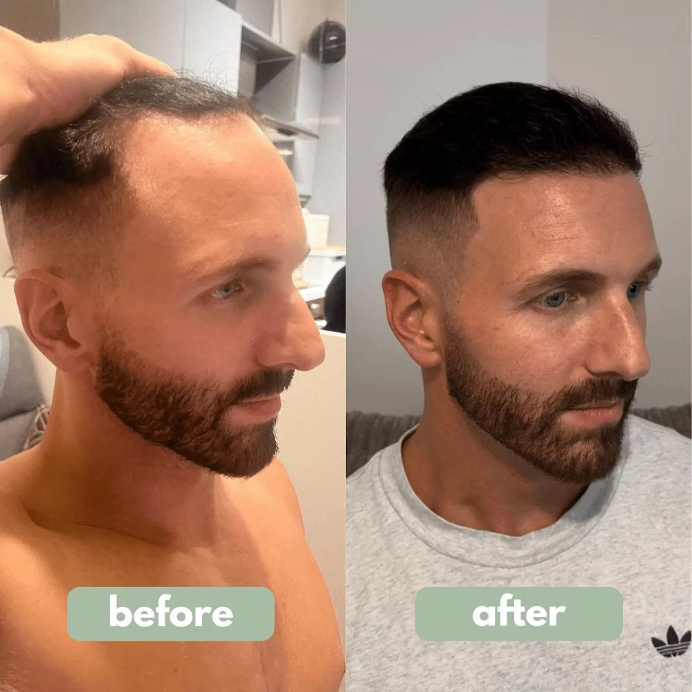Revese - Sérum de Crecimiento Capilar